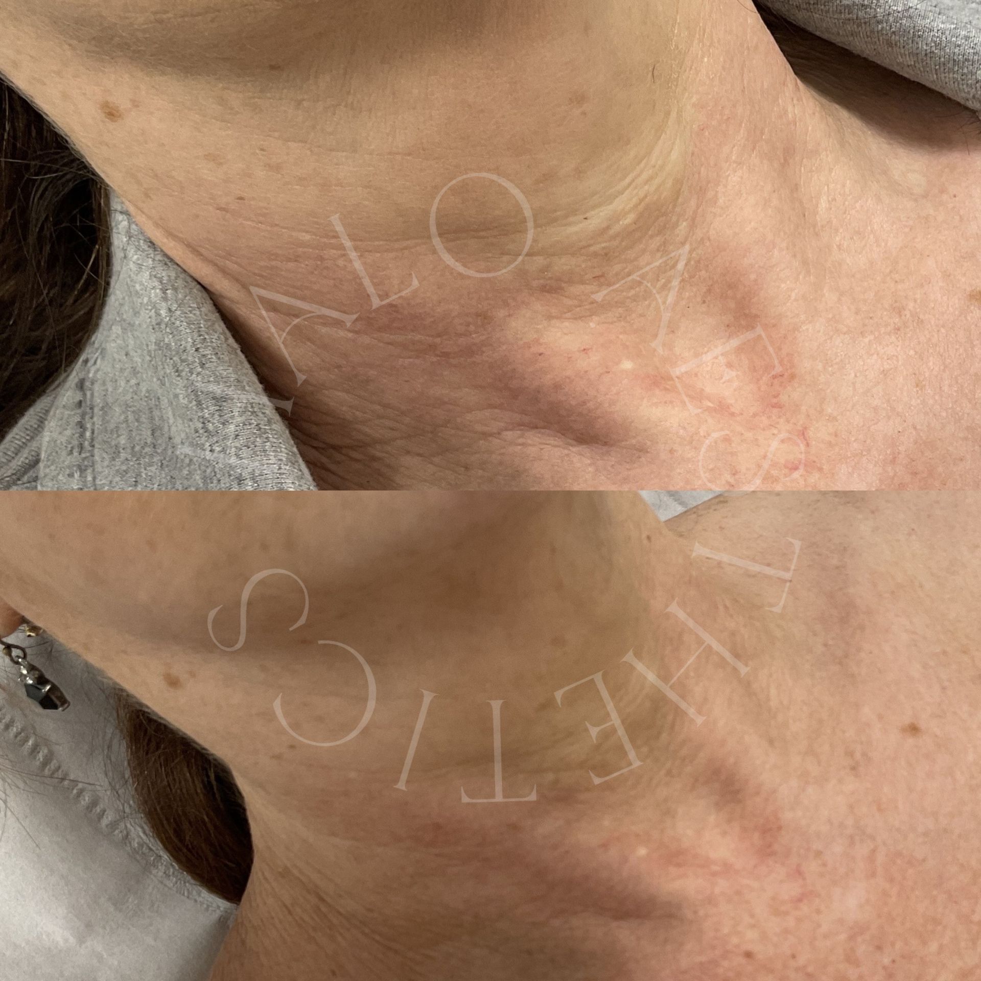 profhilo neck milton keynes