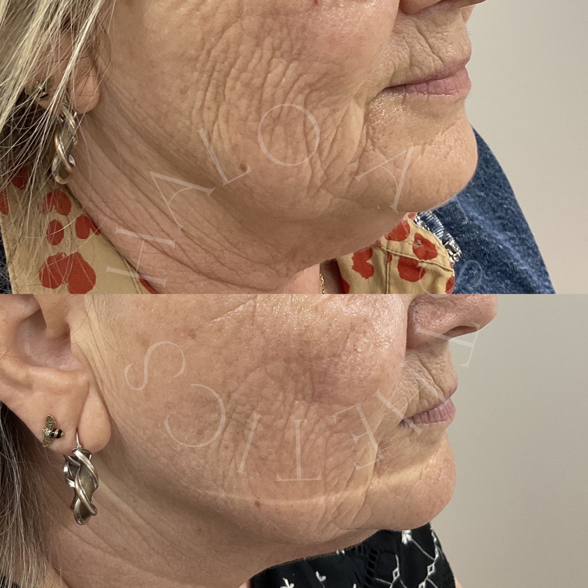 salmon sperm injections milton keynes