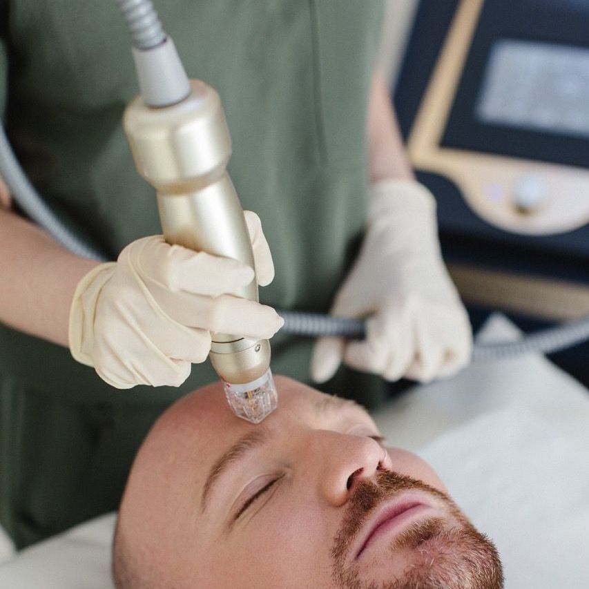 radiofrequency microneedling milton keynes