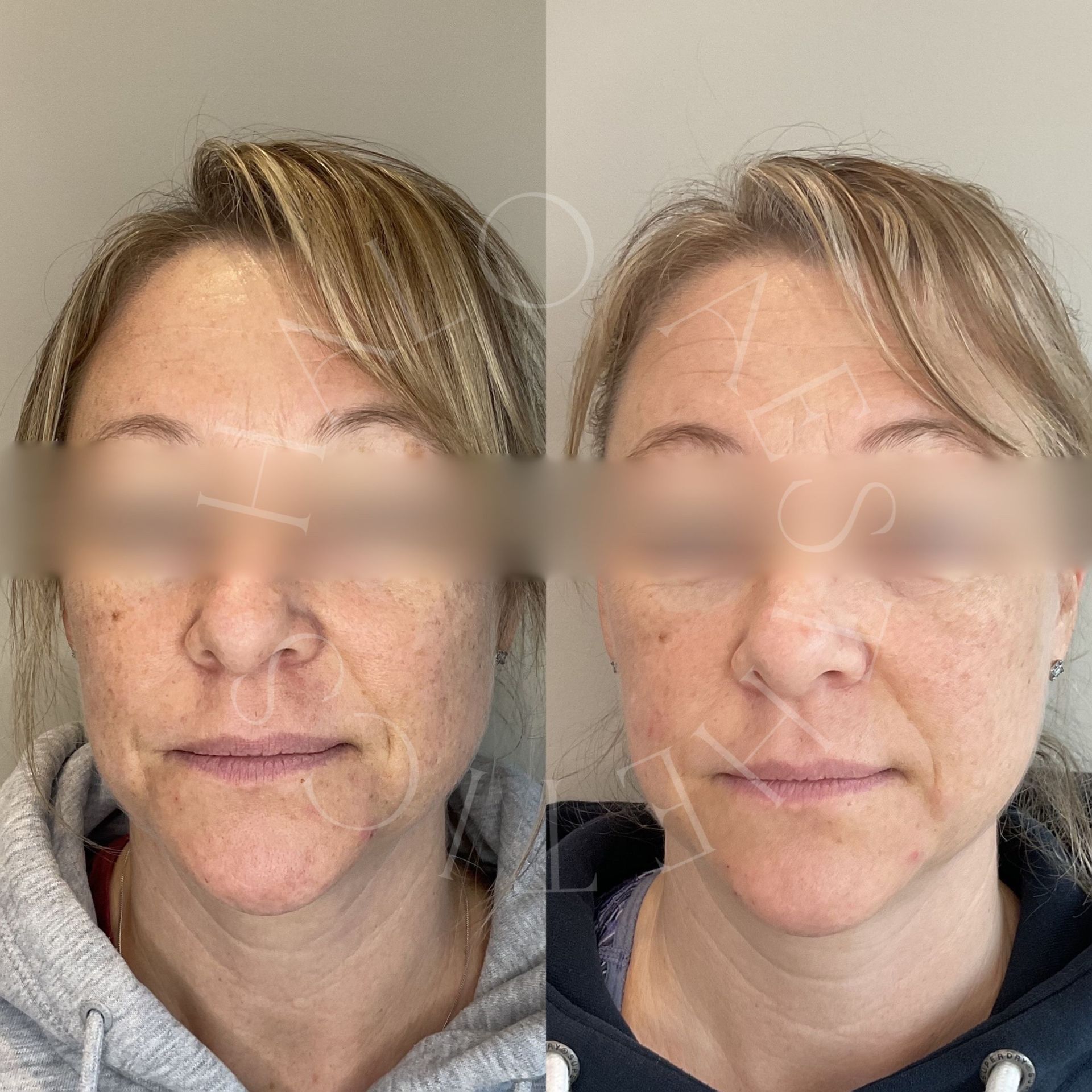 perfect peel milton keynes