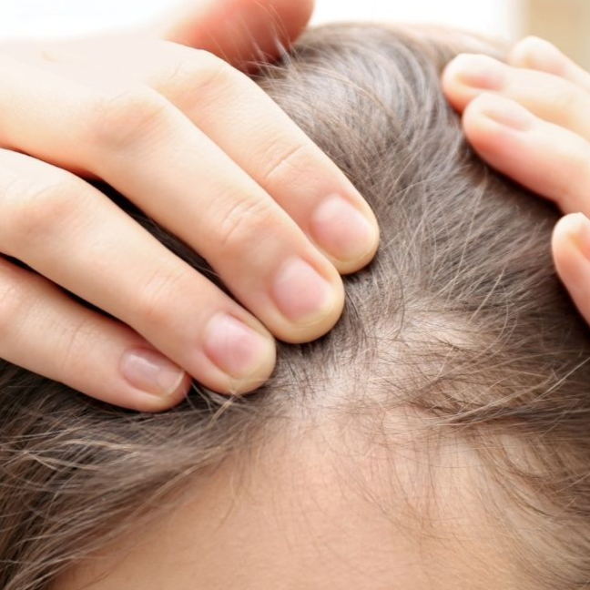 micro needling after