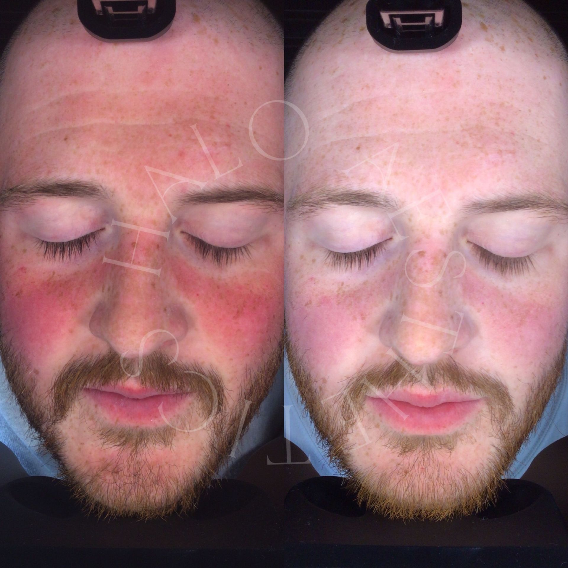 sensitive skin treatment milton keynes