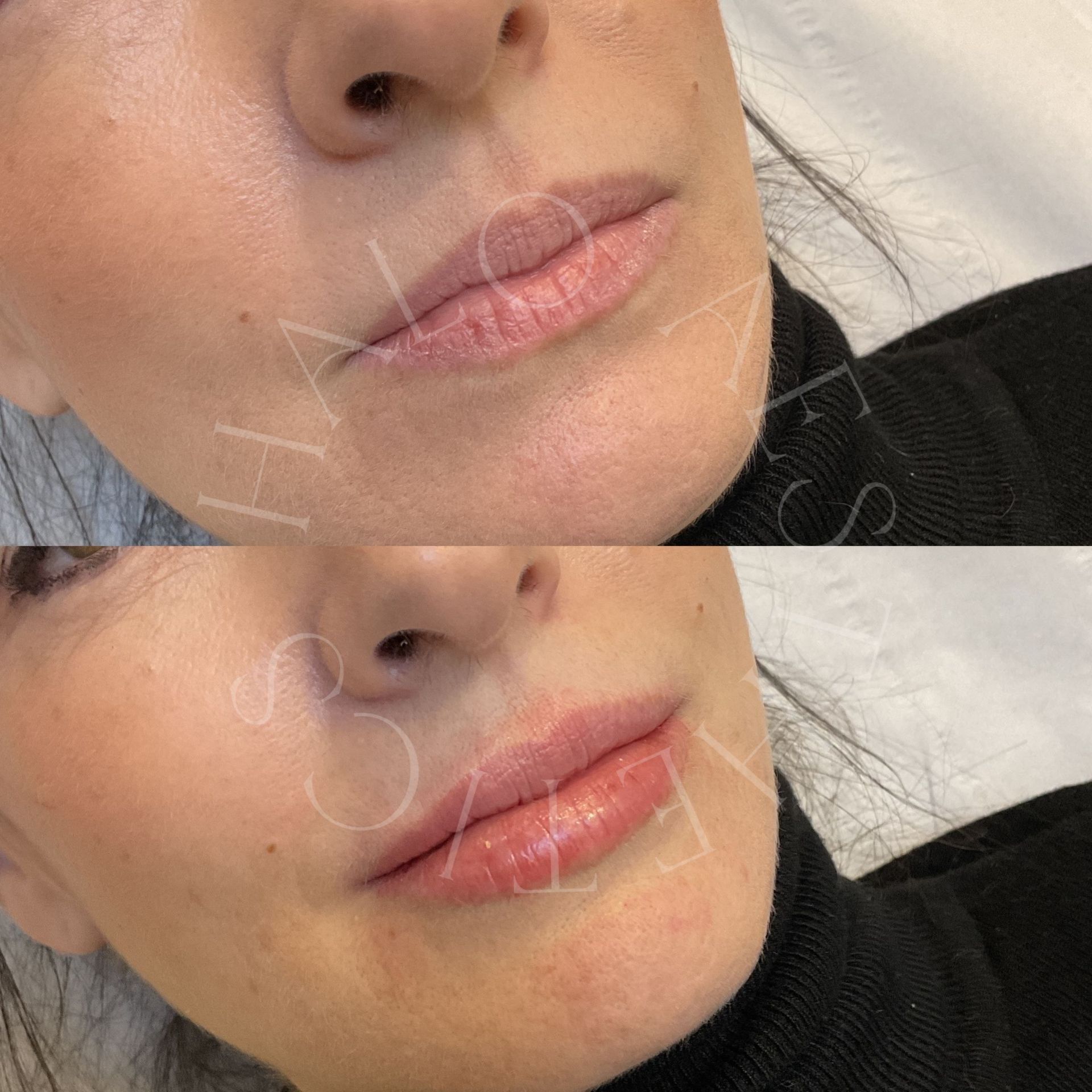 lip filler milton keynes