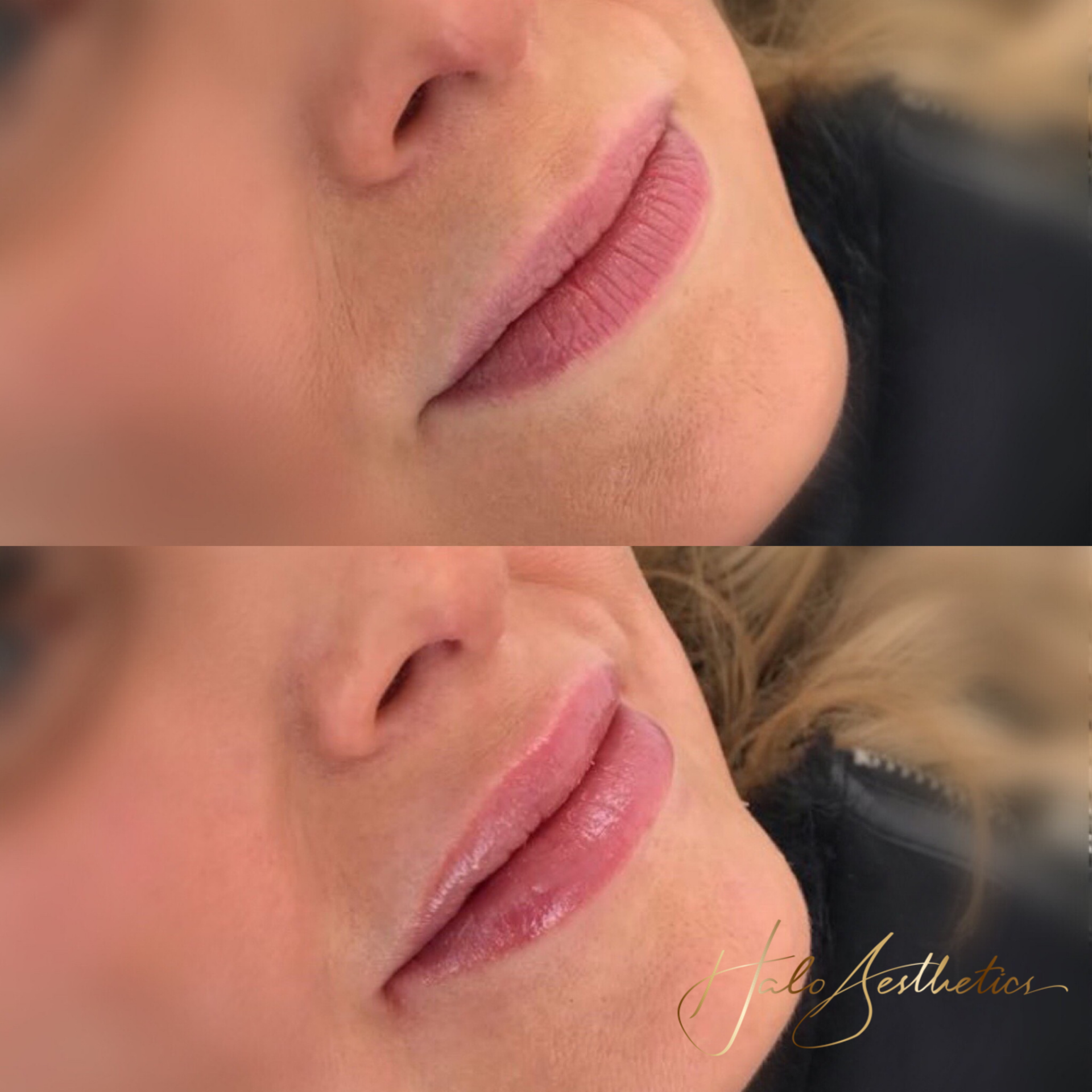 lip treatment results