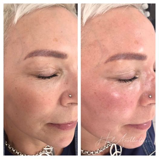 Aesthetics clinic photo guide Milton Keynes