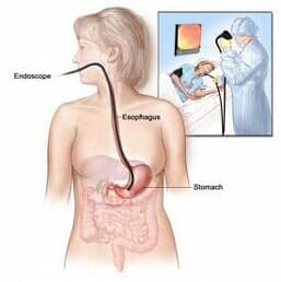 EGD Illustration — Gastroenterology Clinic in Rome, NY