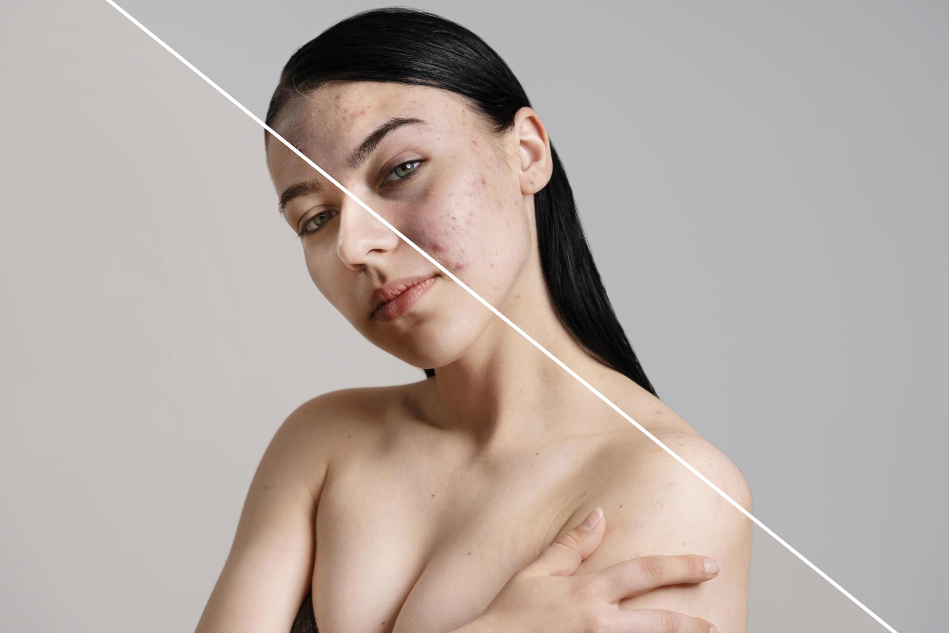 Una foto de antes y después de una mujer con acné en la cara.