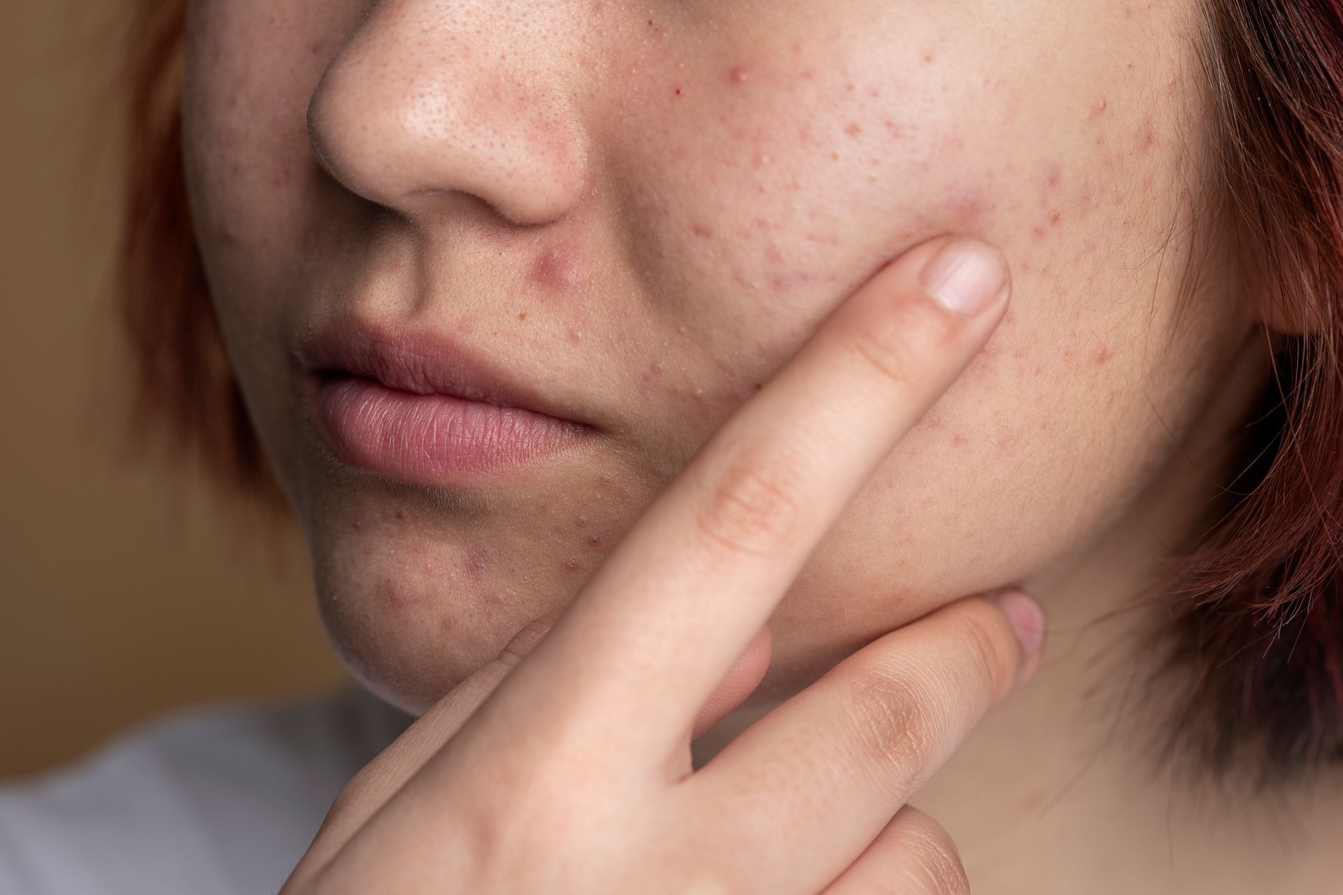 ¿cómo quitar las cicatrices de acné?