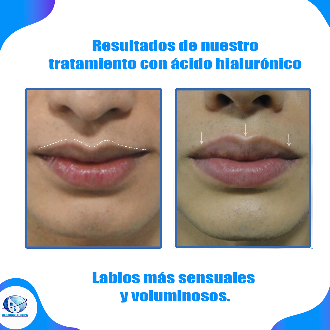 Una foto de antes y después de los labios de una mujer con el título resultados de nuestro tratamiento con ácido hialurónico
