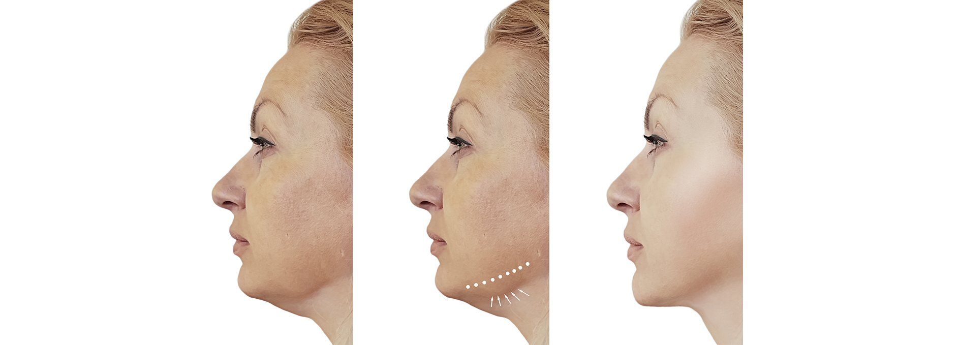 Una mujer recibe una inyección de botox en la cara.