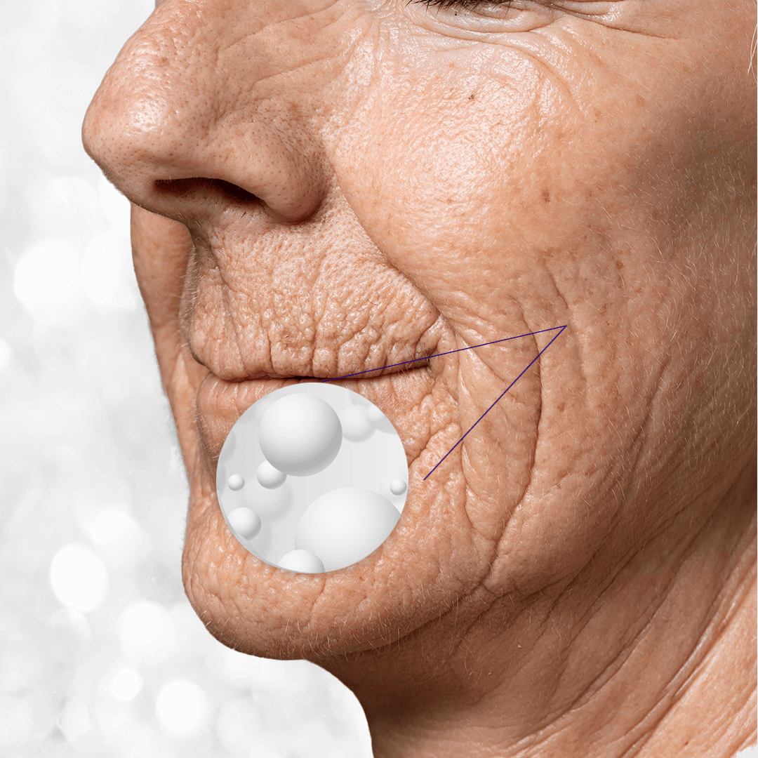 Una mujer recibe una inyección de botox en la cara.