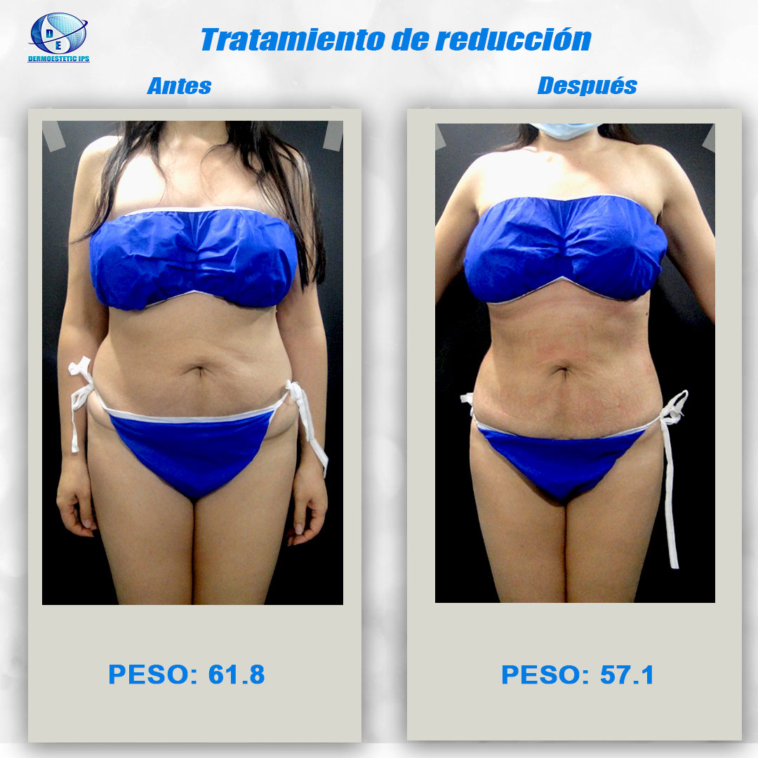 Una mujer en bikini azul pesa 61,8