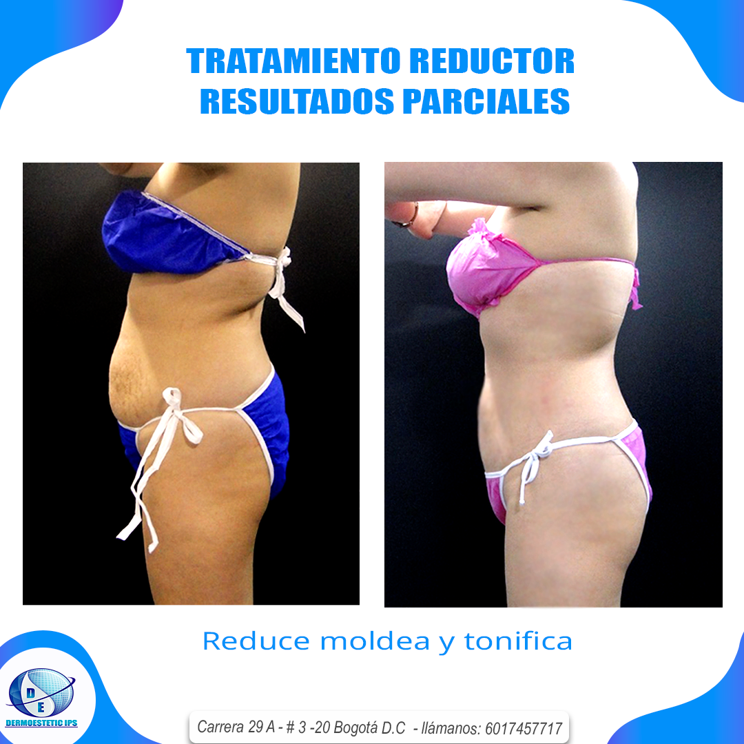 Una foto de antes y después de una mujer en bikini.