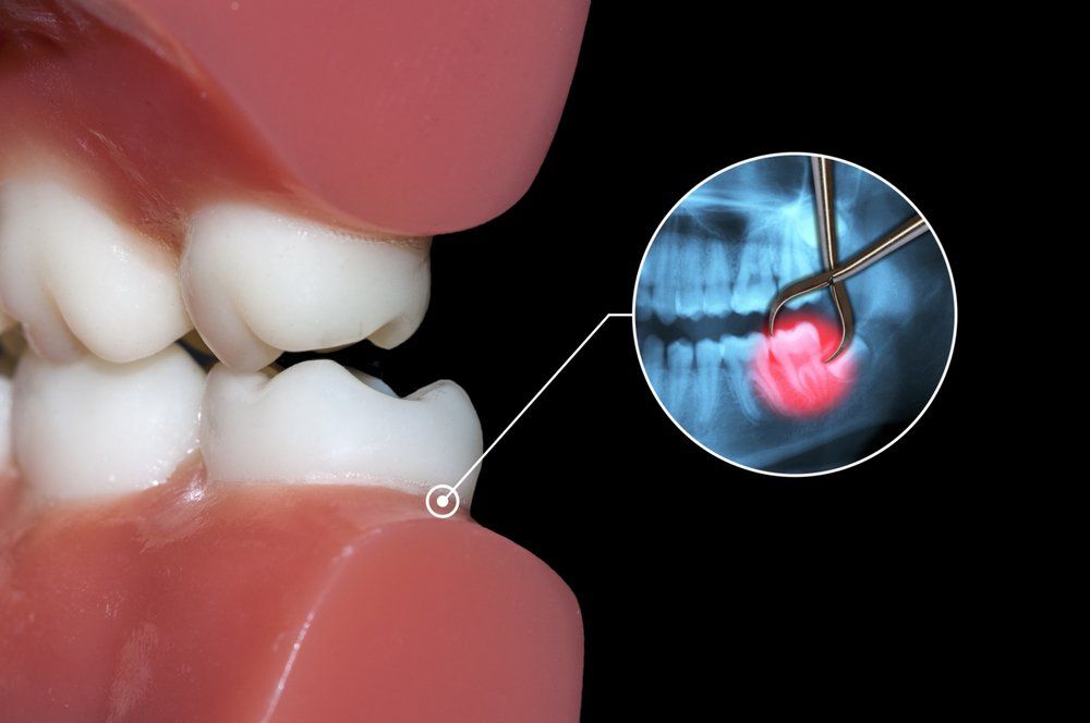 Tooth Extractions & Oral Surgery