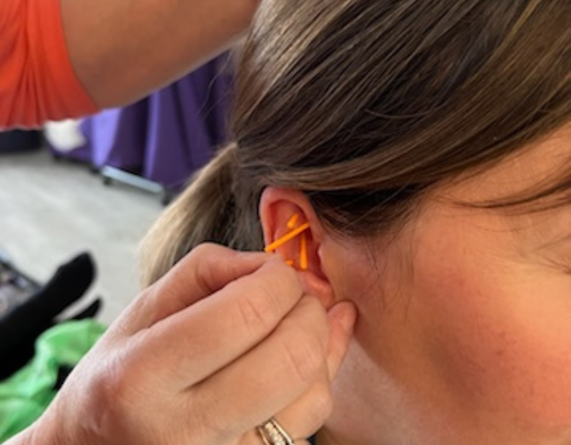Person's ear with multiple orange needles inserted. Another person's hand holds needles. Close-up shot.
