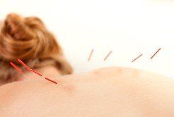 Acupuncture, Acupuncture Clinic, Pain Relief in Clearwater, FL