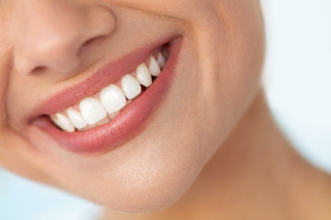 A woman's smile with perfect white teeth