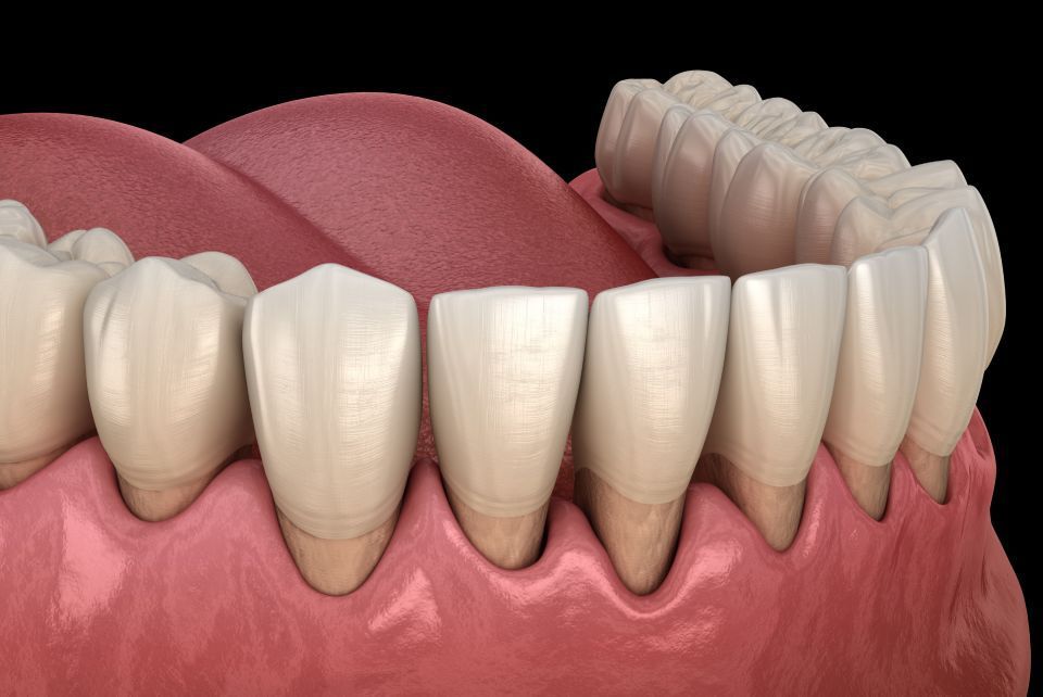 Cure malattie parodontali