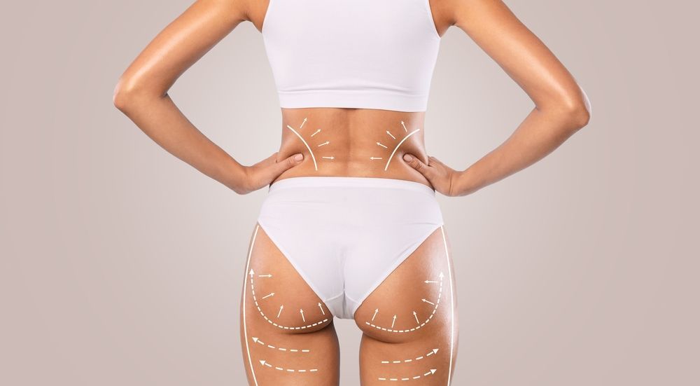 Woman in white underwear, hands on hips, with body markings for cosmetic surgery.