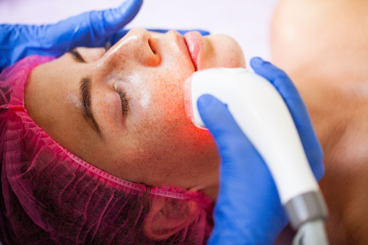 Person receiving facial laser treatment; face, eyes closed; red light visible; blue gloved hands.