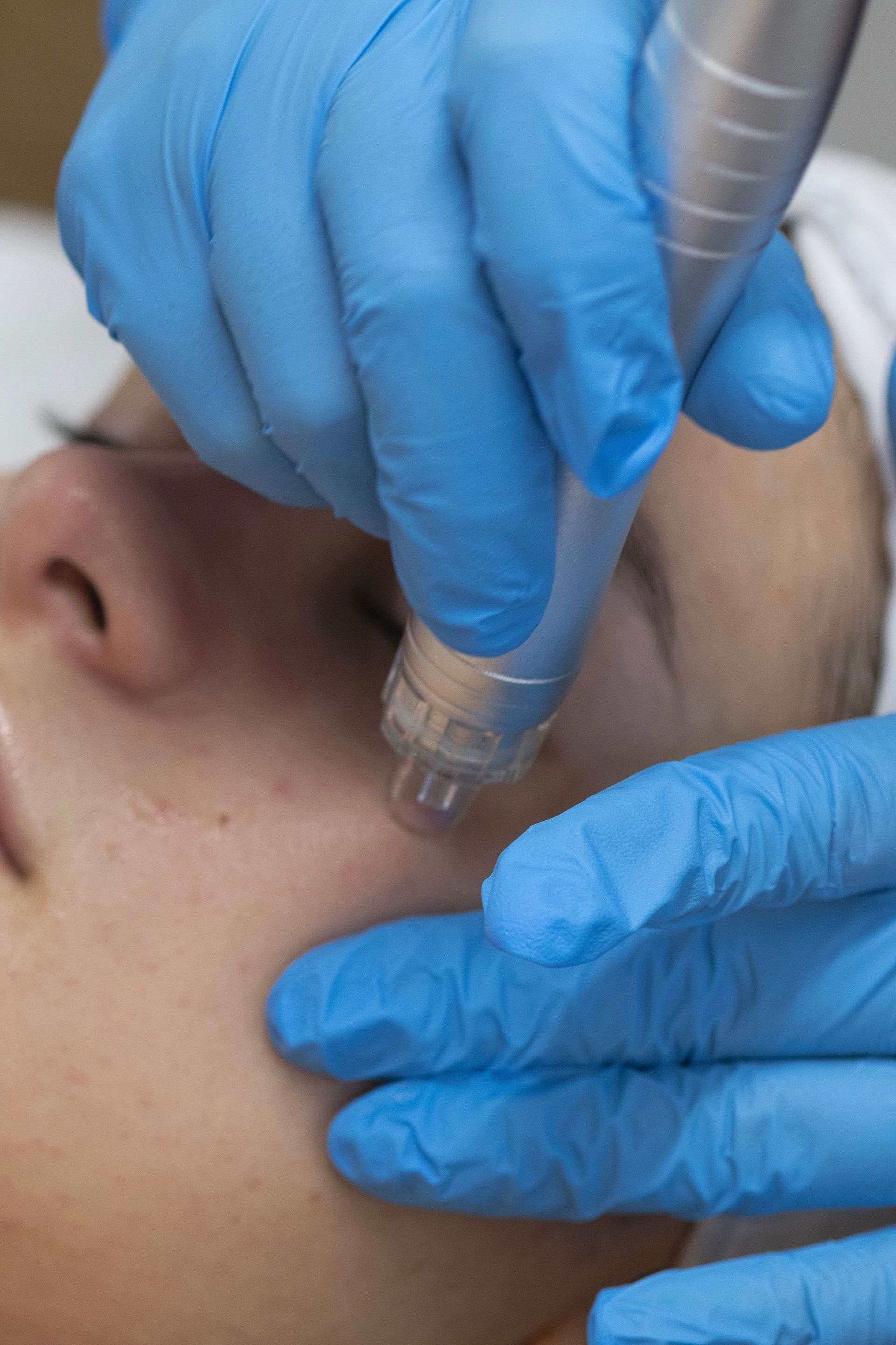 A person wearing blue gloves is getting a treatment on their face.