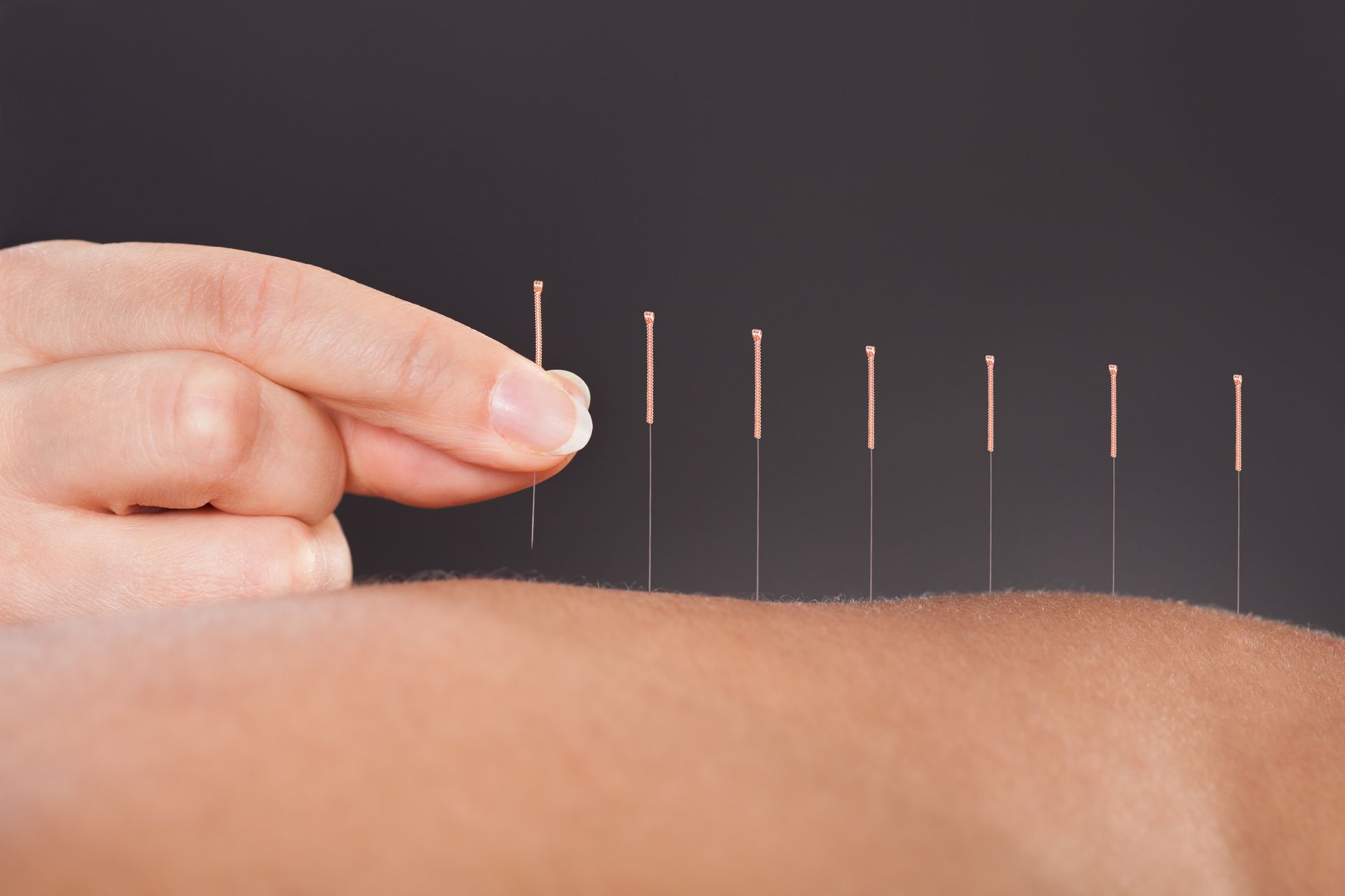 acupuncture near me 