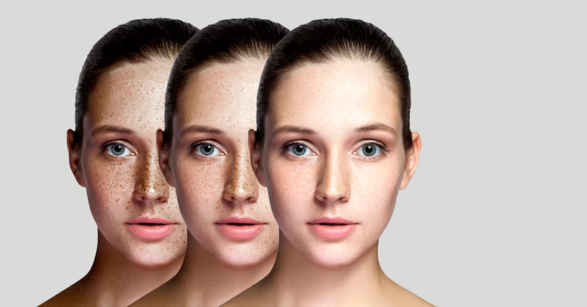 What Are the Common Symptoms of Skin Pigmentation?