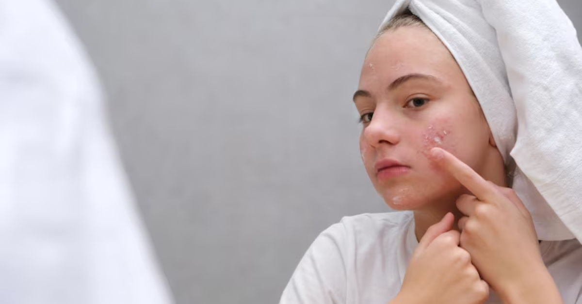 Are Hydrafacials Good For Acne?