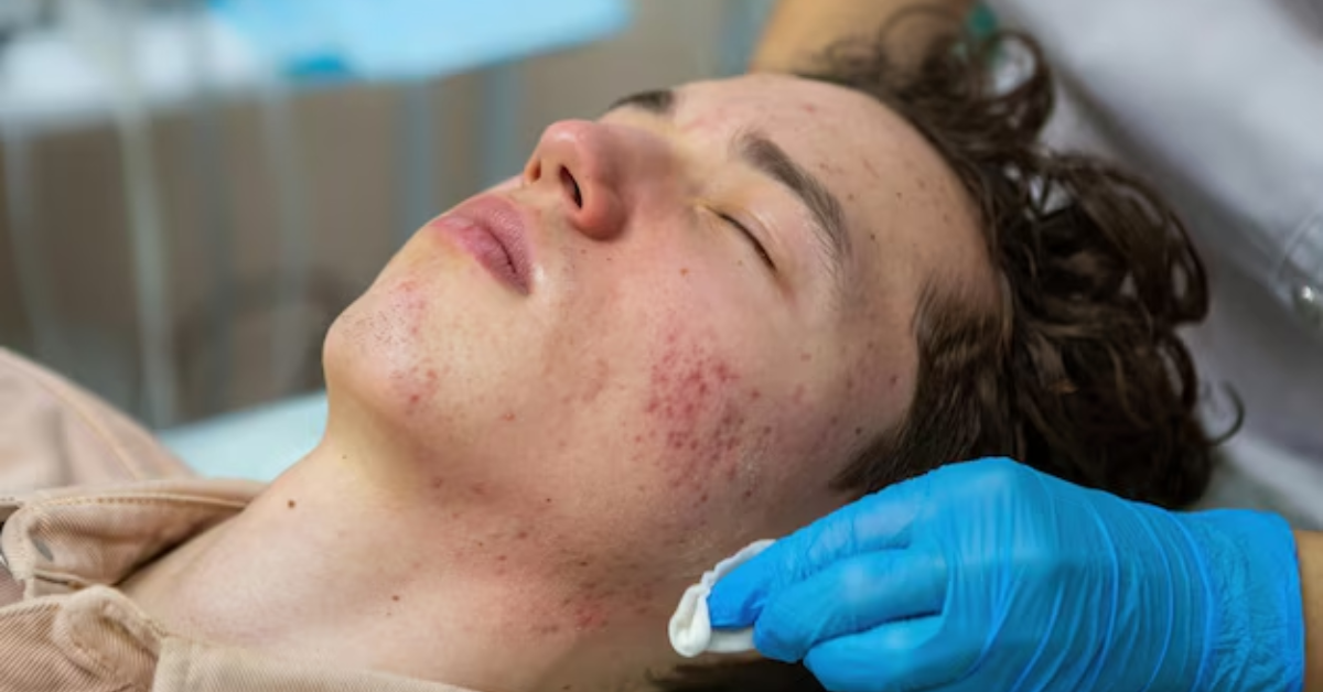 How Long Does It Take to Treat Adult Acne Scars?