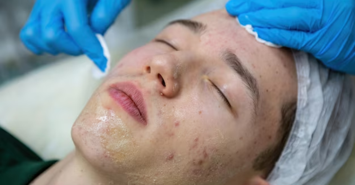 What Types of Acne Scars Are Most Common in Adults?