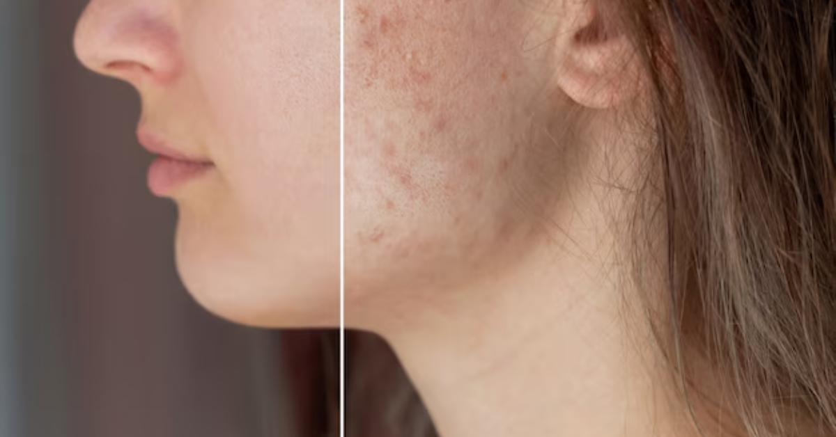 How Do I Know If My Acne Scars Are Pitted or Pigmented?