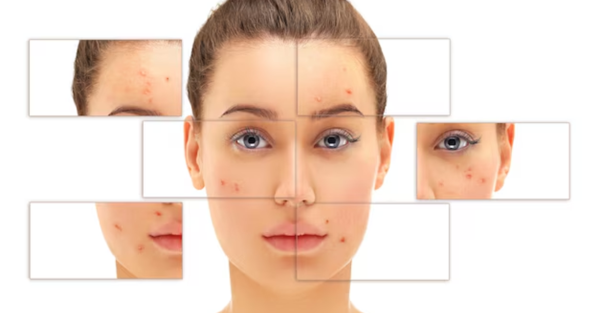What’s the Difference Between Acne Marks and Acne Scars in Adults?