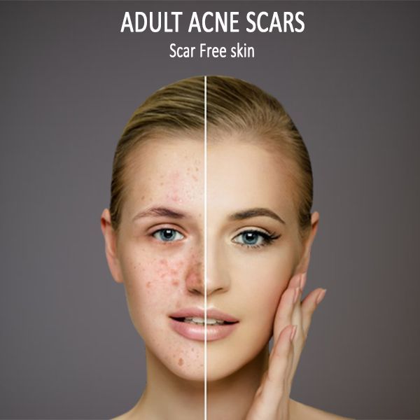 adult acne scars