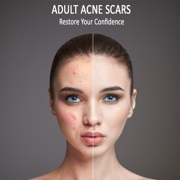 adult acne scars