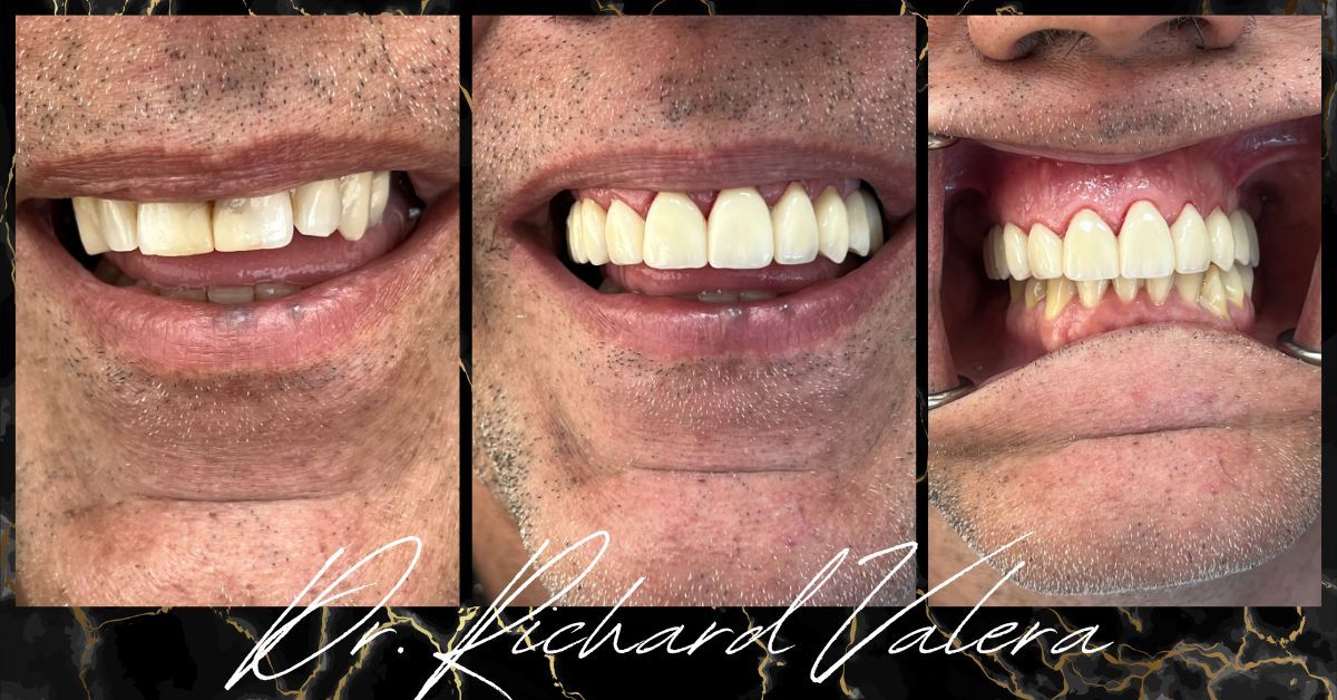 dr richard valera before and after 2
