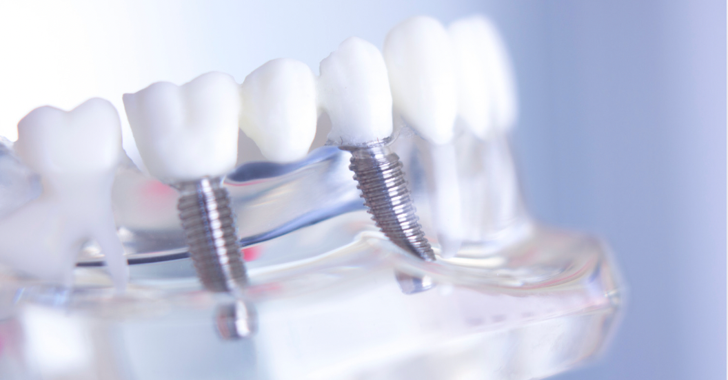 Benefits of dental implants over dentures