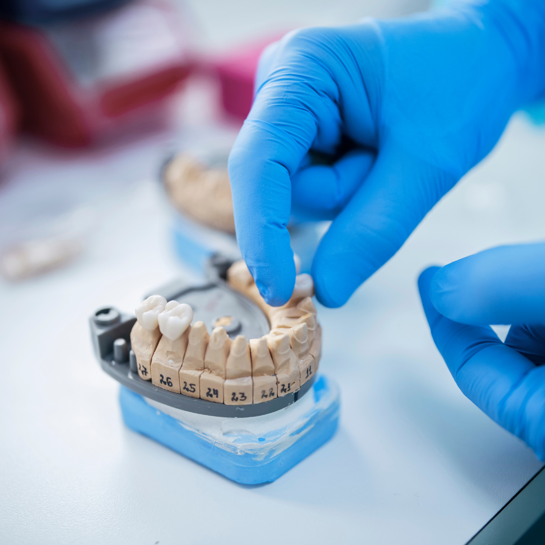 The Process of Getting a Dental Bridge: Step-by-Step Guide