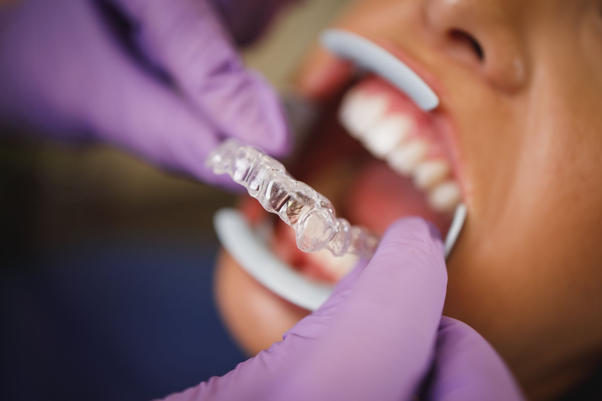 Can I Get Invisalign® If I Grind My Teeth?