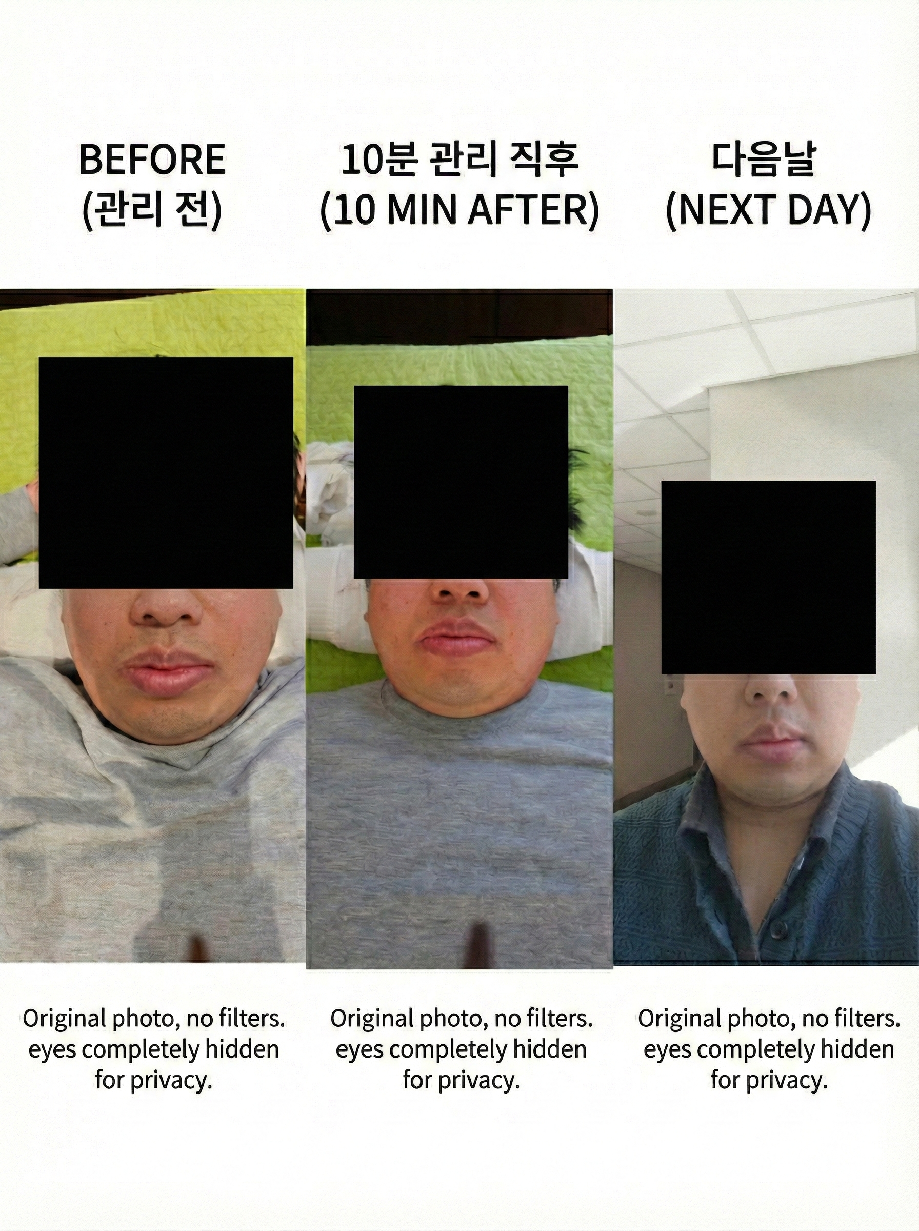 Immediate result after 10 minutes of Korean deep tissue face massage and 1 days after