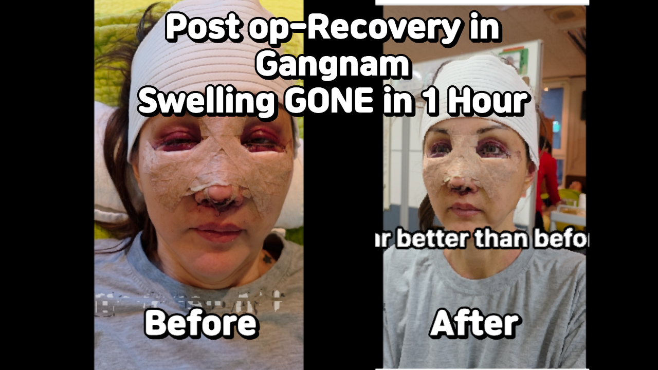 Post plastic surgery swelling care in Gangnam without touching face