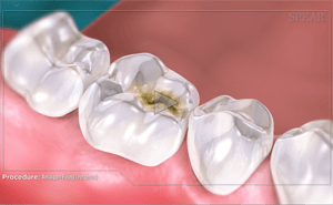 Teeth with a cavity; a dental illustration shows the affected tooth in detail, with the cavity visible.