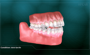 Dental model showing an anterior open bite, where front teeth don't meet when biting down.