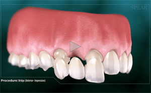 3D rendering of a dental bridge procedure, showcasing teeth with a missing tooth replaced by a bridge.