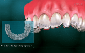 A close-up of teeth with a clear aligner and the aligner model. A medical diagram.