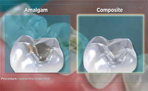 Comparison of tooth fillings: Amalgam (silver) and Composite (white).