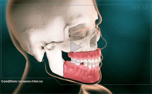 3D rendering of a skull showing jawbone in red, with missing teeth. Condition: Consequences of bone loss.