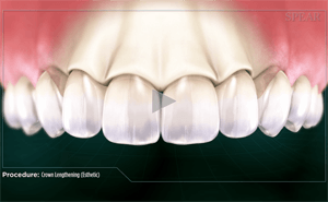 Animated teeth model demonstrating cosmetic crown lengthening.