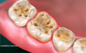 Teeth with dental cavities, highlighted in red.