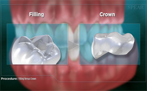 Dental comparison: Filling versus Crown on teeth; showing placement & shape differences.