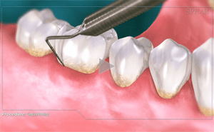 Tooth scaling, close-up of dental tool removing plaque from teeth.